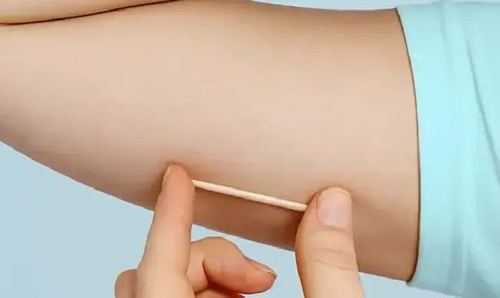 Anvisa amplia validade contraceptiva do Implanon no Brasil; confira a novidade 