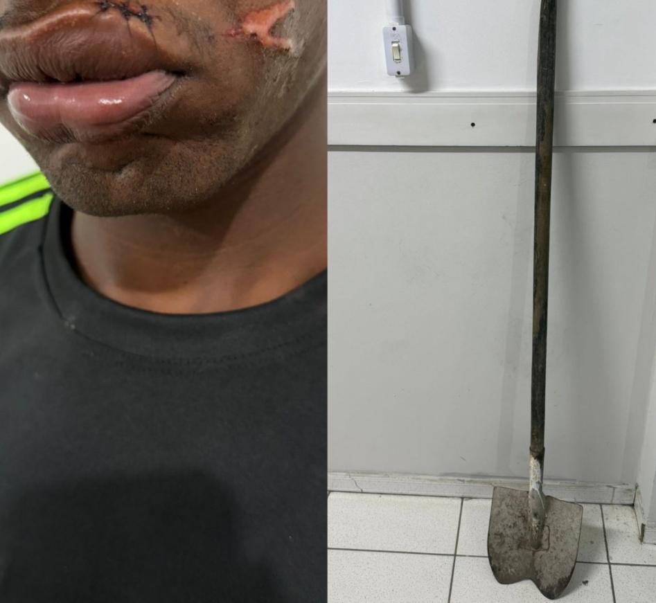 Jovem é agredido com pá pela companheira em Barrocas