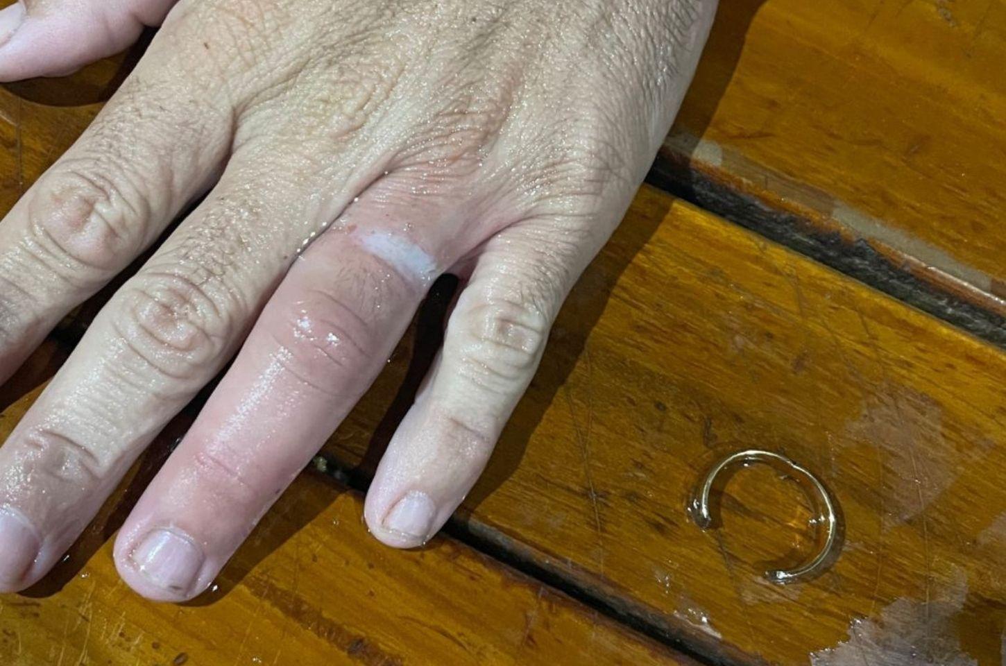 Homem tem dedo preso em aliança e é socorrido em Conceição do Coité