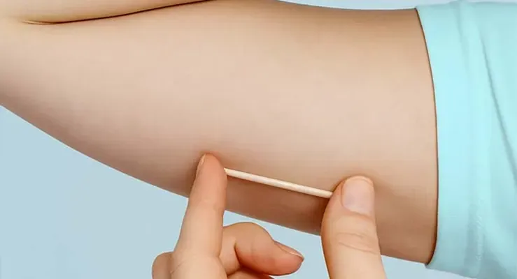 Anvisa amplia validade contraceptiva do Implanon no Brasil; confira a novidade 